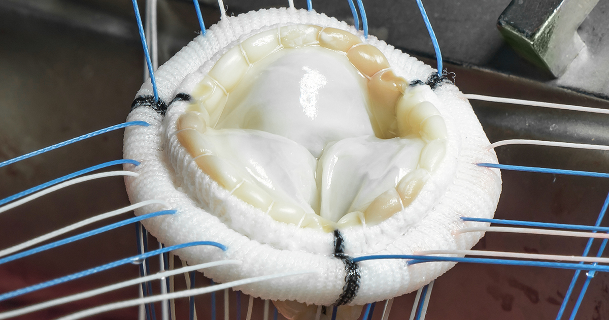 Beratung zu biologischen Herzklappenprothesen in der Bochumer Kardiologie |  Kardiologie Europahaus
